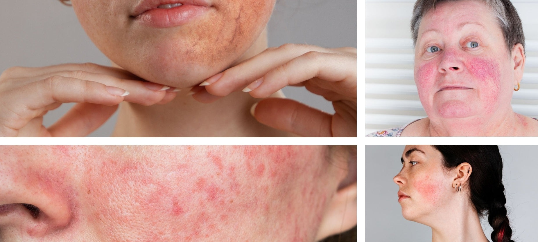 ROSACEA